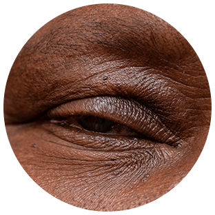 Posterior Ptosis